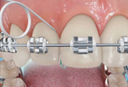 Perfect Smile ortho Flossing steps